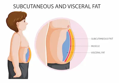 Comparación de abdomen con/sin grasa visceral (ilustración médica).